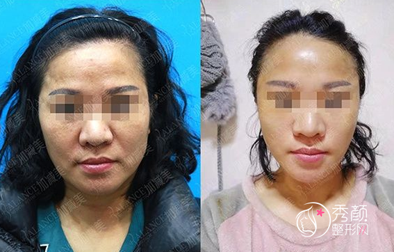 北京加减美穆宝安面部拉皮手术案例