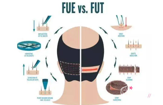 植发技术FUT和FUE有什么区别哪个更好？