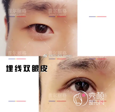 上海首尔丽格朴相根做双眼皮怎么样，附双眼皮案例恢复