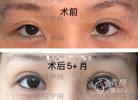 北京八大处修复双眼皮怎么样，附双眼皮修复案例及价格表一览