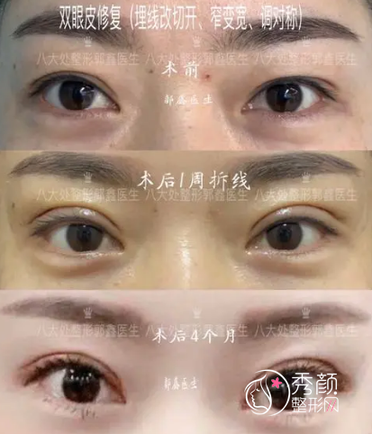 北京八大处修复双眼皮怎么样，附双眼皮修复案例及价格表一览