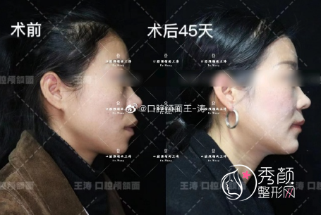 重庆松山医院做正颌手术好吗？肖林和王涛哪个医生好呢？