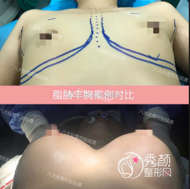 北京八大处自体脂肪隆胸多少钱？附医生介绍及案例分享