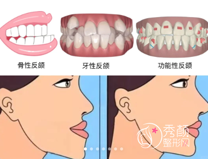 上海九院骨性地包天矫正手术的价格68000元起（包括正颌和正畸费用）