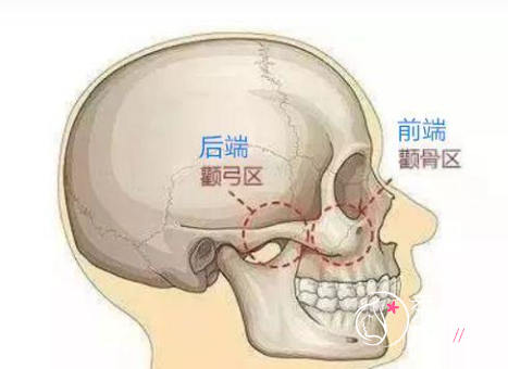 颧骨内推要慎重，能劝几个是几个！看看这几个几个失败案例！！