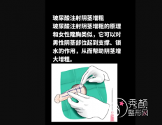 玻尿酸增粗手术可以维持