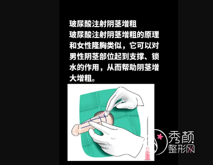 玻尿酸增粗手术可以维持多长时间？玻尿酸增粗手术费用！