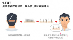 上海九院植发手术有哪些