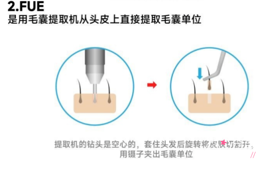 上海九院植发手术有哪些步骤？植发后多久能长出头发？术前需要做哪些准备？