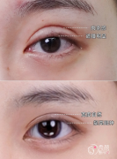 2026全国双眼皮修复