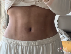 上海吸脂医生排名