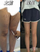 武汉吸脂医生排名