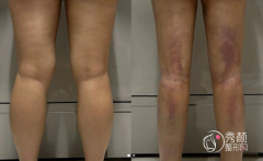 广州吸脂医生排名