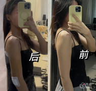 杭州吸脂医生排名