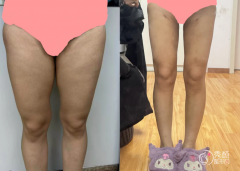 成都吸脂医生排名