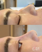 杭州隆鼻医生排名