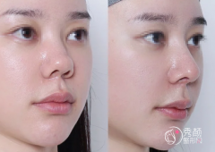 成都隆鼻医生排名