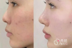 北京隆鼻医生排名