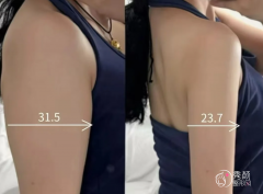 济南吸脂医生排名