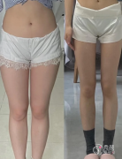 青岛吸脂医生排名