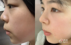 重庆隆鼻医生排名