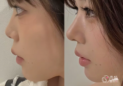 济南隆鼻医生排名