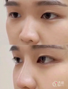 长沙隆鼻医生排名