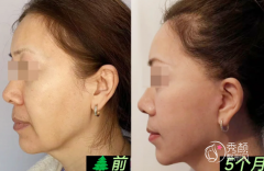 深圳拉皮医生排名