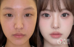 深圳双眼皮医生排