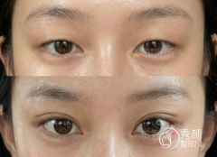 广州双眼皮医生排