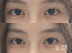 南京双眼皮医生排