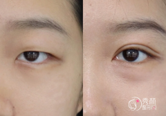 杭州双眼皮医生排
