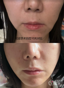 杭州拉皮医生排名