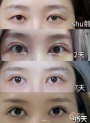 北京双眼皮医生排