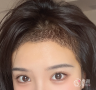 成都植发医生排名