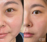 武汉玻尿酸注射医