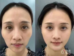 深圳玻尿酸注射医