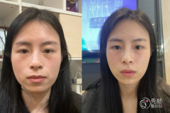 杭州玻尿酸注射医