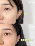 广州玻尿酸注射医