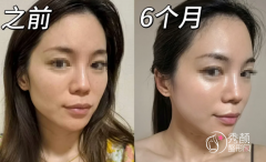 成都玻尿酸注射医