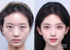 上海玻尿酸注射医