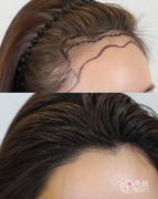 济南植发医生排名