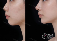 青岛玻尿酸注射医