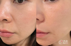 长沙玻尿酸注射医