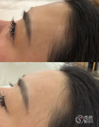 重庆玻尿酸注射医