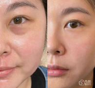 济南玻尿酸注射医