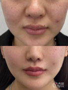 青岛童颜针认证医