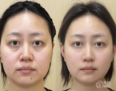 长沙童颜针认证医