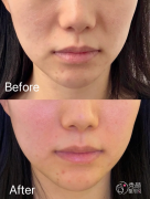 武汉童颜针认证医