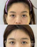 杭州自体脂肪丰面